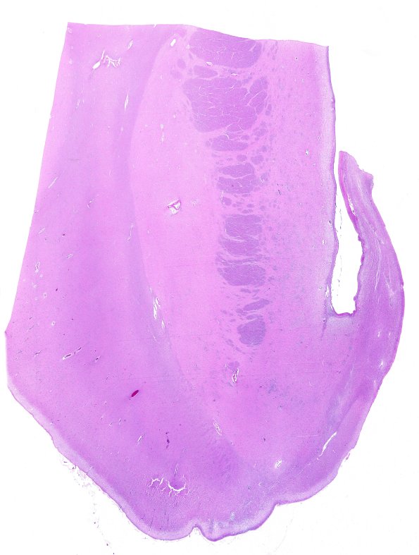 14C1 Huntington's Disease (Case 14) L6 H&E WM