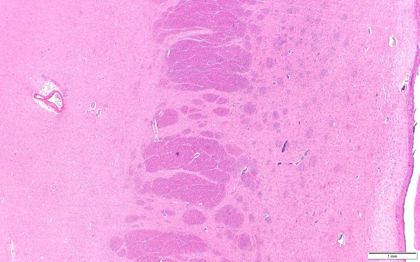 14C2 Huntington's Disease (Case 14) L6 H&E 2X scale