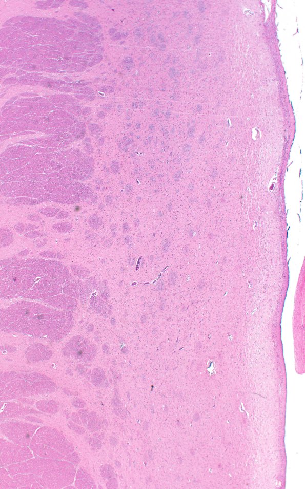 14C3 Huntington's Disease (Case 14) L6 H&E 2X