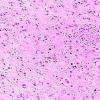 14C4 Huntington's Disease (Case 14) L6 H&E WM 2