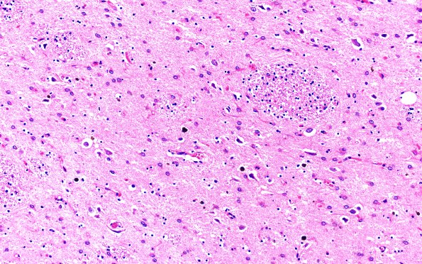 14C4 Huntington's Disease (Case 14) L6 H&E WM 2