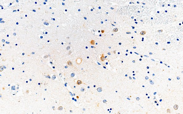 14D1 Huntington's Disease (Case 14) L6 1C2 40X caud