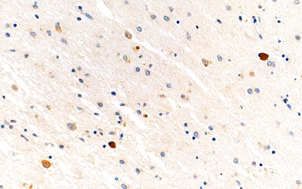 14D2 Huntington's Disease (Case 14) L6 1C2 40X caud (2)