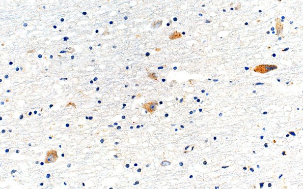 14D3 Huntington's Disease (Case 14) L6 1C2 40X caud