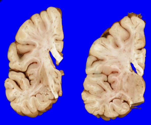 15A4 Huntington's Dz (Case 15)_9