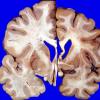 16A3 Huntington's Dz (L) vs Normal Brain (R) Case 16