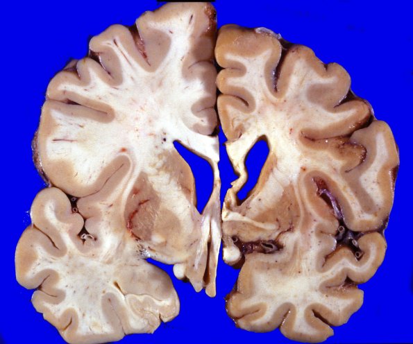 16A3 Huntington's Dz (L) vs Normal Brain (R) Case 16