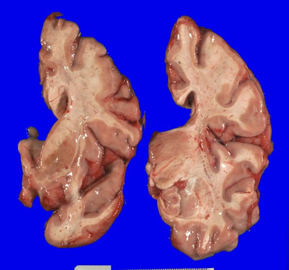 17A2 Huntington's Dz (Case 17) Gross_2