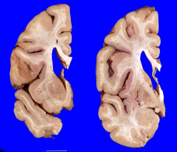 17A3 Huntington's Dz (Case 17) Gross_4