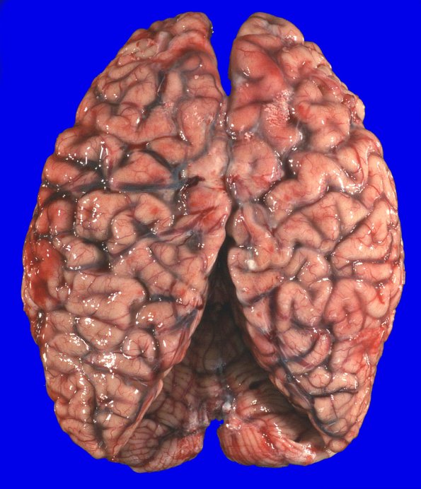 18A1 (Case 18) Gross _2