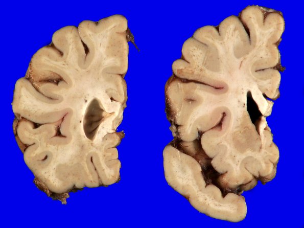18A2 (Case 18) Gross _19
