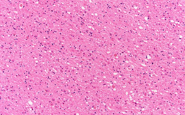 18B2 (Case 18) N2 H&E 20X