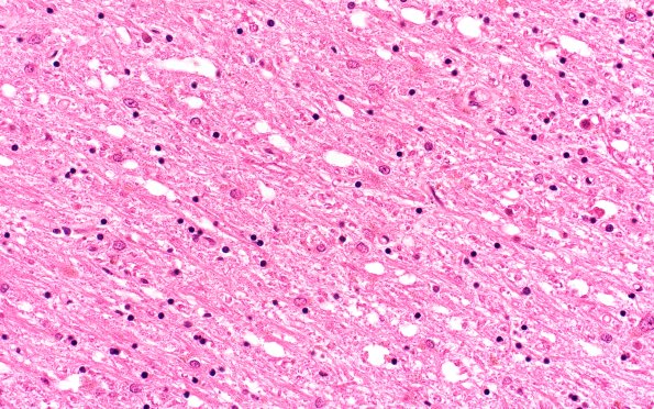 18B3 (Case 18) N2 H&E 40X