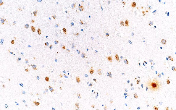 18C1 (Case 18) N2 1C2 H&E 40X 2