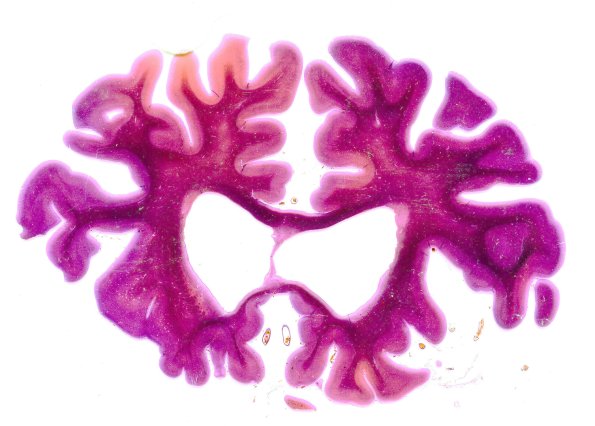 19A Huntington's Dz slab microtome section