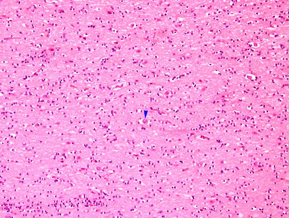 1B2 Huntington's Dz (Case 1) caudate N2 H&E 2 copy.jpg