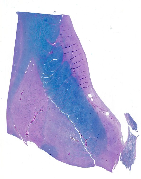 1D1 Huntington's Dz (Case 1) LFB-PAS whole mount