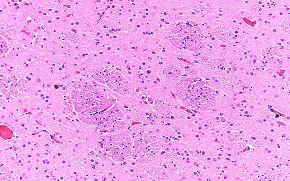 20B2 AD (Case 20) L6 H&E 20X