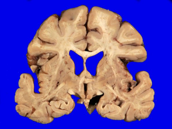 2A2 Huntington's Dz (Case 2)_6