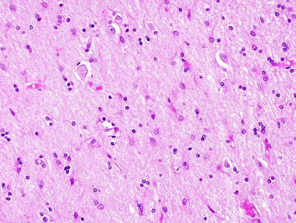 3B2 Huntington's Dz (Case 3) H&E Caudate