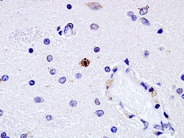 3D1 Huntington's Dz (Case 3) 1C2 (Anti-polyglutamine) 3