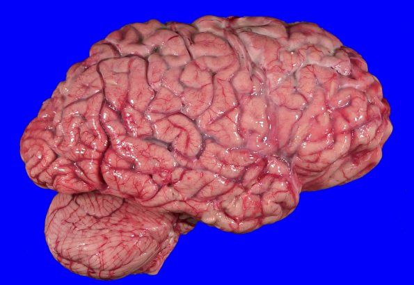 4B1 Huntington Dz (Case 4) _5