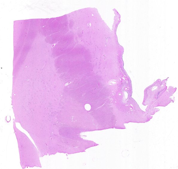 4C1 Huntington Disease (Case 4) L17 WM