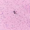 4C2 Huntington Disease (Case 4) L17 20X 2