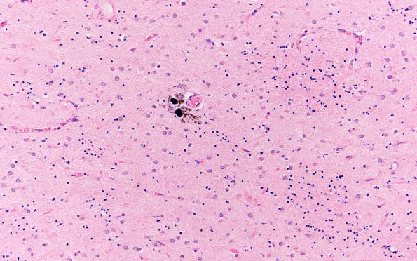 4C2 Huntington Disease (Case 4) L17 20X 2