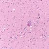 4C3 Huntington Disease (Case 4) L6 20X 2