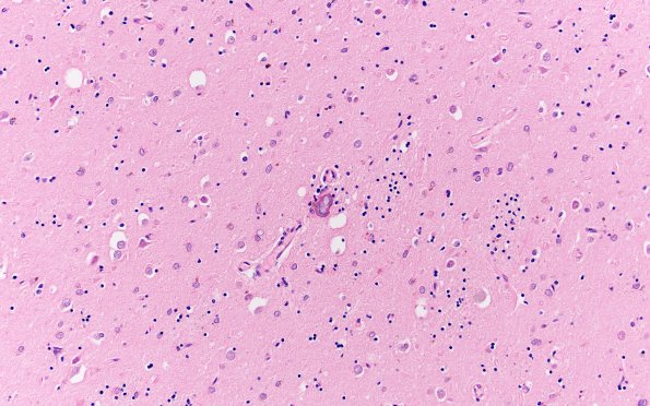 4C3 Huntington Disease (Case 4) L6 20X 2