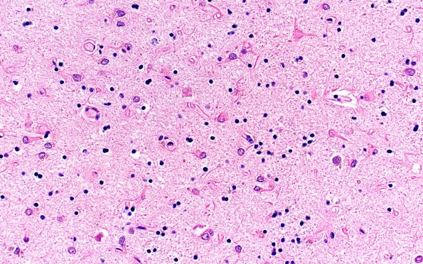 4C4 Huntington Disease (Case 4) L6 40X 2