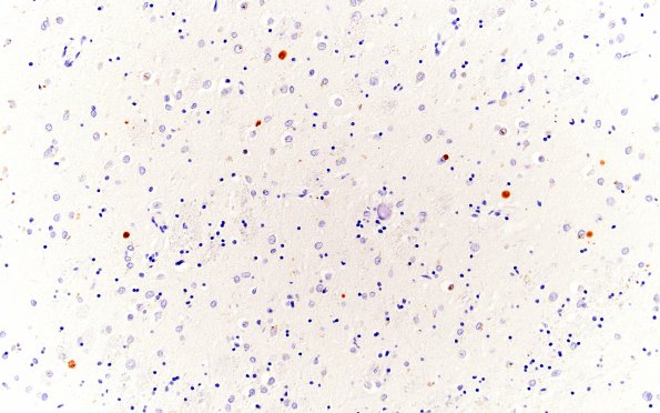 4D Huntington Disease (Case 4) L6 20X 2