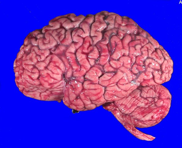 5A1 Huntington Dz (Case 5) _2