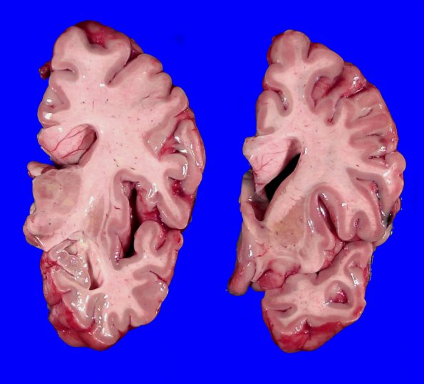 5A2 Huntington Dz (Case 5) _3