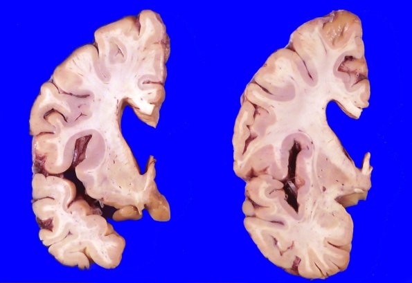 5A3 Huntington Dz (Case 5) _8