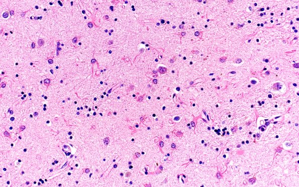 5C3 (Case 5) N2 H&E N2 40X