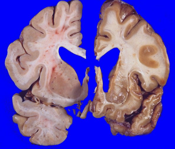 6A3 Huntington's Dz (Case 6)  2