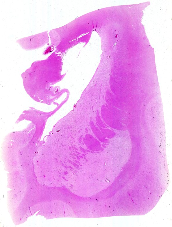 6B1 (Case 6) N2 WM H&E 2 WM