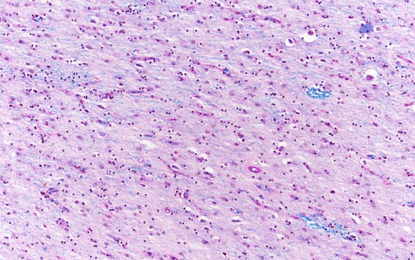 6C3 (Case 6) N2 WM LFB-PAS 20X 2