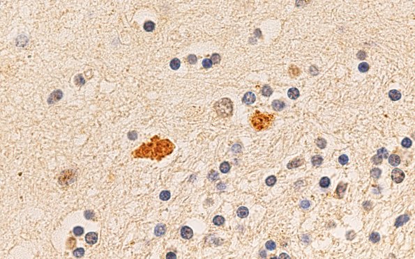 6D (Case 6) N2 Ubiq 100X