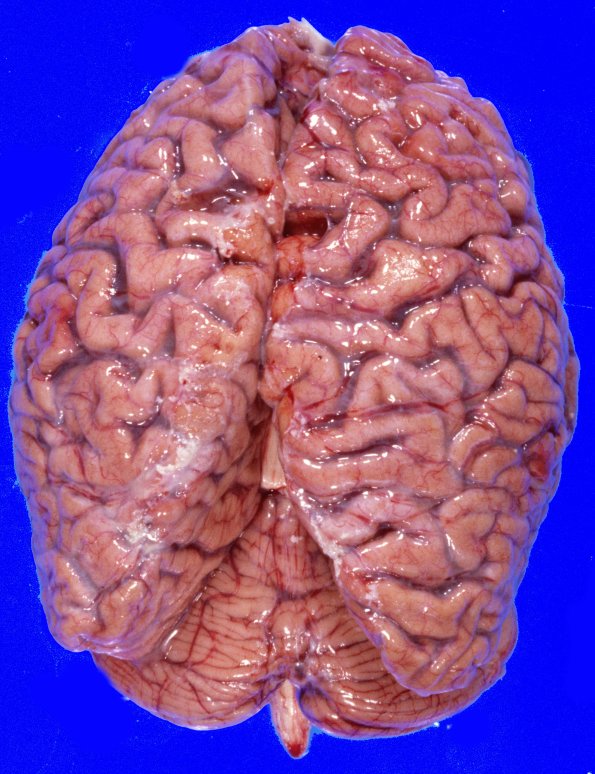 7A1 Huntington's Dz (Case 7) 7