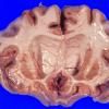 Huntington Disease