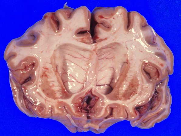 7A2 Huntington's Dz (Case 7)