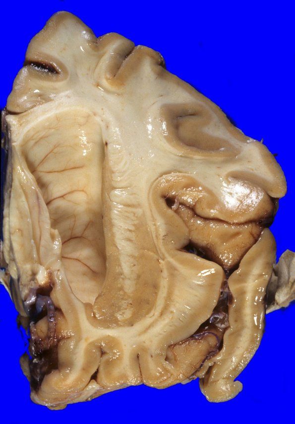 7A3 Huntington's Dz (Case 7) 3