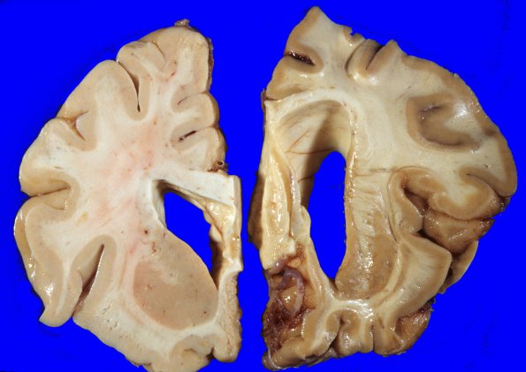 7A4 Huntington's Dz (Case 7) 5