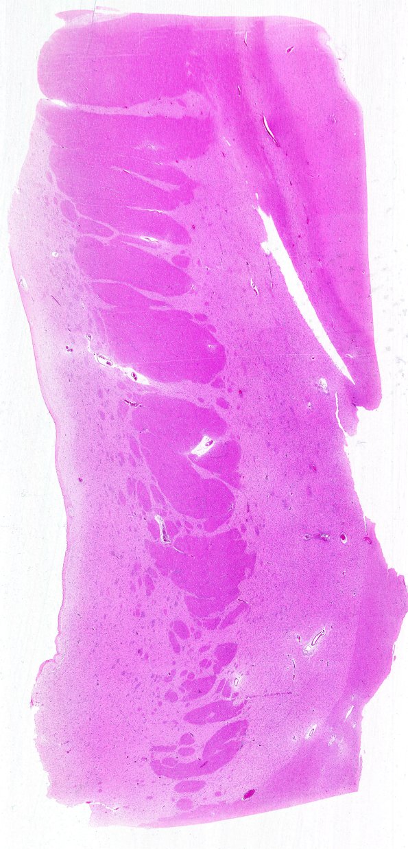 7B1 Huntington's Dz (Case 7) WM (H&E)