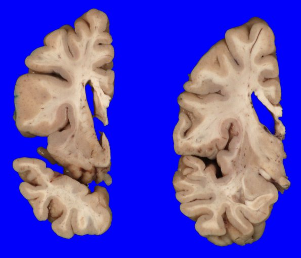 8B4 Huntington's Dz (Case 8) gross_13