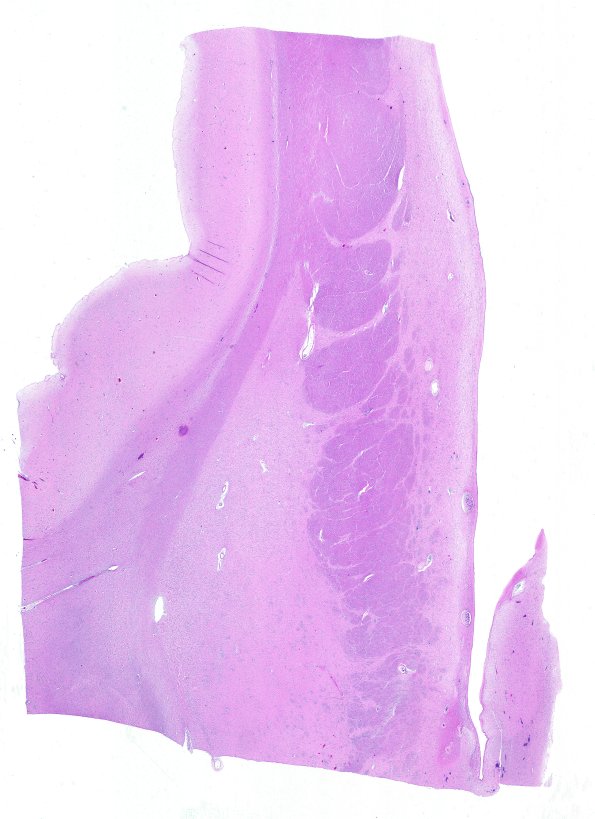 8E1 HD (Case 8) L6 H&E WM