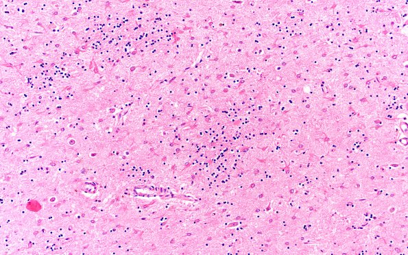 8E2 HD (Case 8) L6 put 1C2 40X